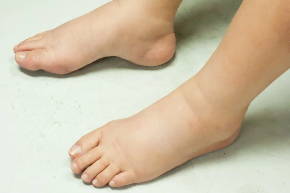 Cause-foot-edema-diabetic-patients