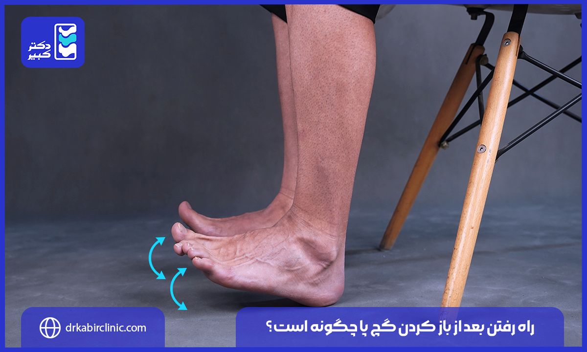 راه رفتن بعد از باز کردن گچ پا چگونه است؟