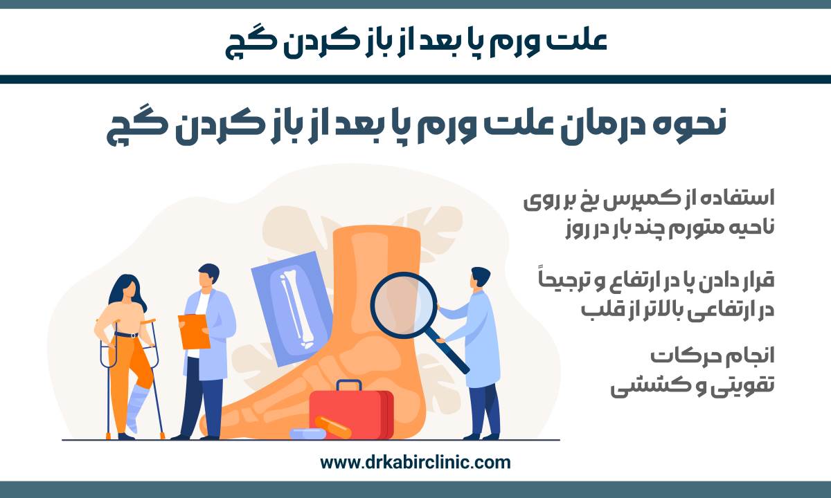 نحوه درمان علت ورم پا بعد از باز کردن گچ
