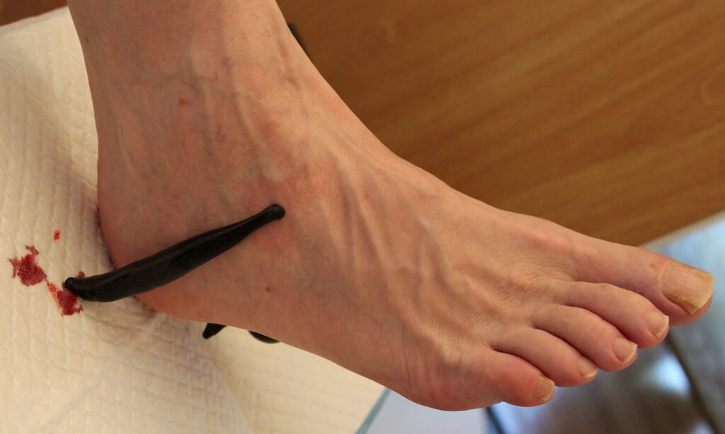 Leech-treatment-leg-swelling