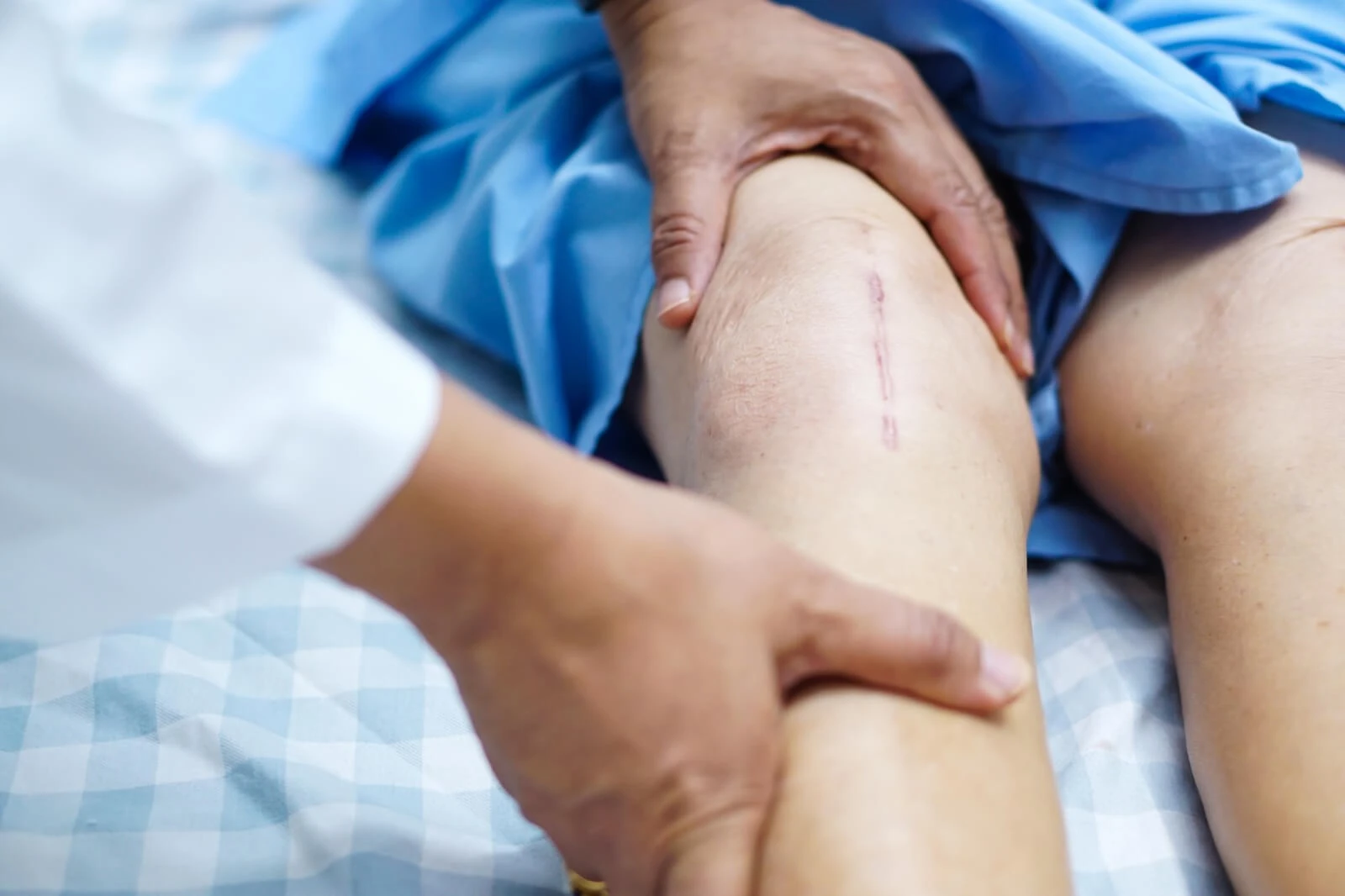 Leg-swelling-knee-replacement-surgery