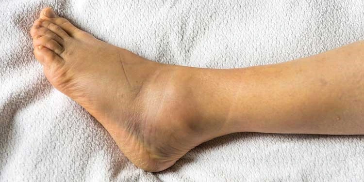 Treatment-leg-swelling-fracture