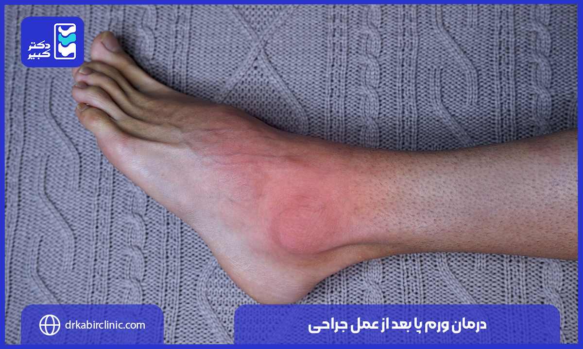 درمان ورم پا بعد از عمل جراحی